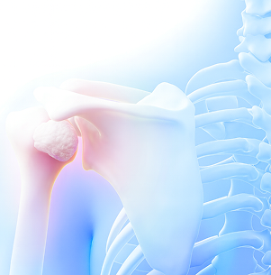 어깨에 발생하는 대표적인 질환 이미지