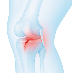 무릎에 발생하는 대표적인 질환 이미지