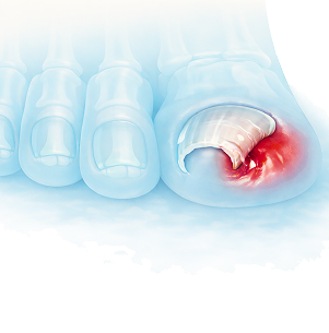 하지에 발생하는 대표적인 질환 이미지